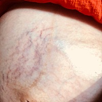 为什么你这么淡定。纹一天比一天多。肚皮快撑破了。求发动，求见红。38+2已入盆