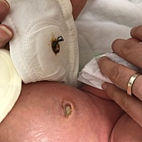 宝宝脐带脱落后，有乳白色的东西，当时没清理掉，现在结痂了，每天还是在用碘伏消毒，要紧吗？结痂会不...