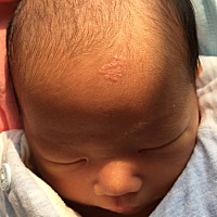 孩子额头上有块斑一样的东西，有宝妈知道是什么吗，后期可以消退吗