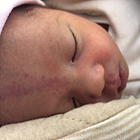 宝宝出生额头就有红色印记，今天第10天没消退，有宝妈知道是什么吗？