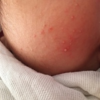 这是湿疹还是热疹，搽药好多天也不行，今天身上也长了