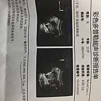 怀孕41天 真的是难受 一坐车就吐 坐一次吐一次 心里也不舒服 老是想吐😩😩😩 天天都想睡觉