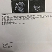 第一次做B超，有胎心胎芽了，但是盆腔有积液，大夫告诉积液有点多，给开的保胎灵和黄体酮，求助，慢慢的...