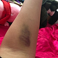 前两天去医院查了个血，然后回家就这样了，睡觉都疼怎么办呀？