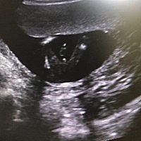 3个月屁股方向B超，看得出来女宝宝男宝宝吗