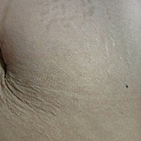 产后一年三个月，肚子上的妊娠纹还是那么明显        体重100斤，想瘦到90。妊娠纹真的是折磨疯了...