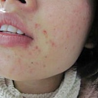 皮肤油  痘痘暴涨  有没有控制的方法