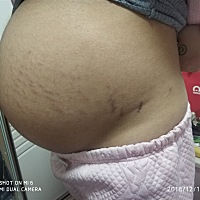 之前一直没长 千防万防没想到要生了居然给我长妊娠纹 真是😱😱