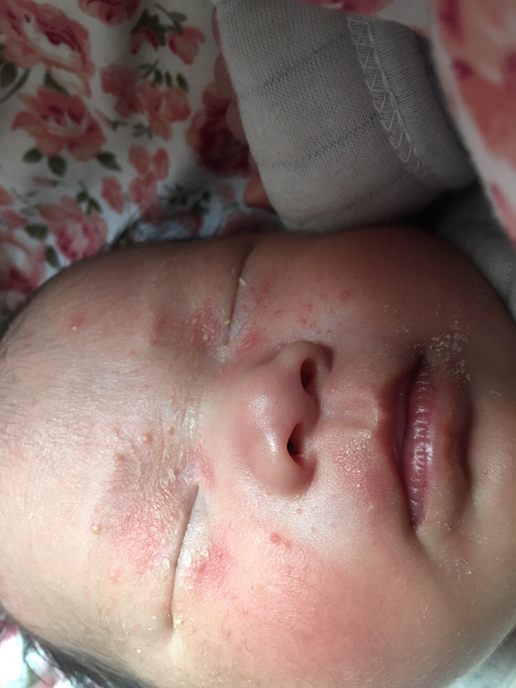 请问这种湿疹怎么办？应该涂抹什么？饮食方面应该注意什么？