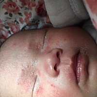 请问这种湿疹怎么办？应该涂抹什么？饮食方面应该注意什么？