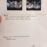 12.6号末次，今天去监测卵泡，16mm，要多久会排？医生建议明天继续监测，用大卫试纸测已经强阳两天了，...