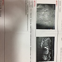 孕六周左右12月18号下午见红，肚子胀胀的跟来姨妈一样，一直持续到晚上十二点左右大出血，上厕所流了不...