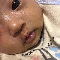 求助！宝宝鼻子下面的红点点是啥 是不是胎记啊 四十几天了还没消