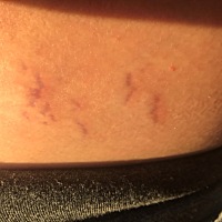 开始长纹了，一千多的油白买了。三个月摸了几天，肚子不大就不抹了，5个月开始每天晚上抹。有两天肚子痒...