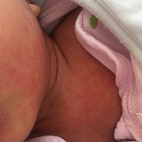 孩子是穿太多衣服了吗？是湿疹吗