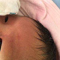 自从晒完太阳 出现小白泡 怎回事