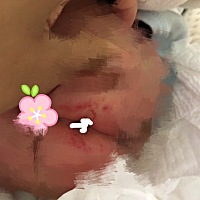 小屁屁破皮，一直反复跪求支招啊，心痛。