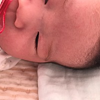 宝妈们 有没有知道宝宝眼皮有红血丝是什么情况的 宝宝三个月了 还是没有退下去