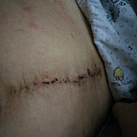 十五天我才不要纱布，今天拆了，粘贴皮肤过敏红的，这个刀疤三刀