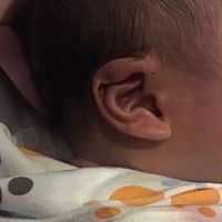 宝宝生下来耳朵有点皱，这样以后会好吗？有宝妈的孩子有没有相同的情况？