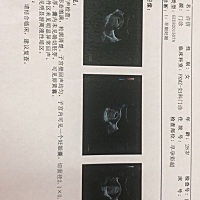 我今天孕7周+2天，本来是打算元旦去照B超看下胎心胚胎的发育情况，那会就满8周了。 前几天没吃去上厕所...