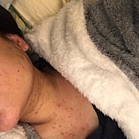 孕晚期最后两个月，都长满了，有点痒，越抓越多，现在宝宝已经出生了，宝妈们有什么药可以推荐一下吗？