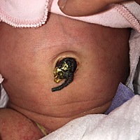 宝宝才18天 大腿内侧有湿疹怎么办？亲们