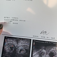 b超写着双胎囊双胎芽是异卵双胞胎还是同卵双胞胎啊，