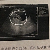 大家帮忙看看 我这是孕囊吗