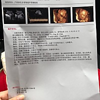 没有预约，医院人很少！280大洋，医生说像宝爸！不知道是不是暗示是女孩呢？哈哈我的直觉告诉我是女孩