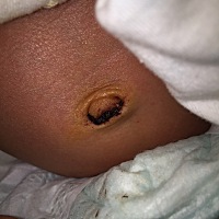 脐带掉后有血痂，需要去医院处理吗？在家一直都在用碘伏消毒。