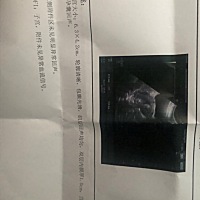 急！停经38天，B超单如下。会不会是宫外孕？
