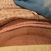 剖腹产14天后的肚子和伤口！虽然伤口上面的皮肤还没有知觉，但是已经没有那么痛了！肚子已不能看！让我...