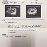 16年圣诞节晚上做的宫外孕右侧输卵管切除手术，术后半年医生建议左边输卵管做造影，看看是否有问题，听...