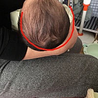 宝宝头扁了怎么还能睡过来么？第26天，还没满月……感觉是扁，不是歪……对比两边像少了一圈一样，...