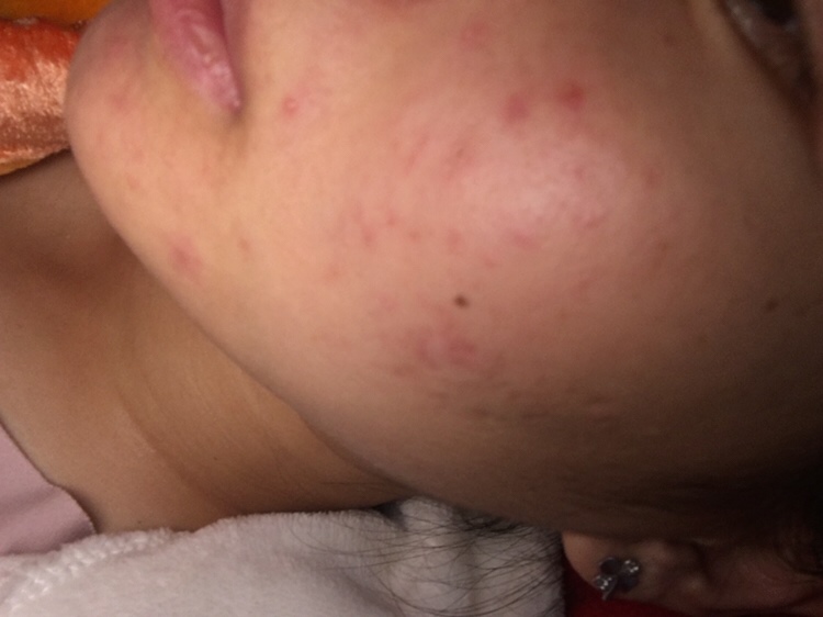 我这张脸该怎么办啊，生完孩子脸上这两天开始冒痘痘，不知道是不是月子里一直吃红米酒炖鸡吃的上火还是怎么的，

我该怎么办啊，我要毁容了
有什么办法没有？