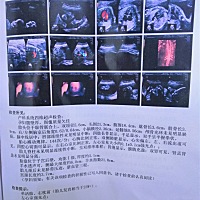 新鲜的四维出炉了， 医生说左心室强光点百分之五十的娃都会有， 大家以后遇到这种也不要担心， 哇咔咔，...