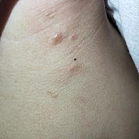 图一是最开始的，去医院说是湿疹， 过一个星期更严重了 （图二）去复查又说丘疹性荨麻疹，白天还好 晚...