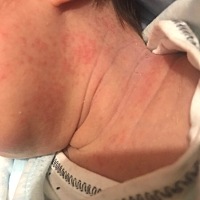 急急急，有没有妈妈们遇到这种情况的，两边脸颊下巴一圈都长，红红的点！怎么办，她好像会痒，这两...