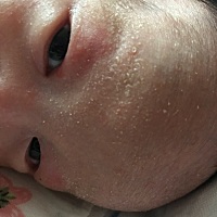 宝妈们，宝宝脸上这个是湿疹还是奶癣啊，能推荐一下你们都给宝宝涂什么吗