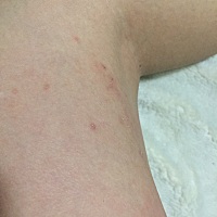 腿上特别特别痒，什么原因啊，就想一直不停的抓，有宝妈这样的吗，要擦什么药膏……