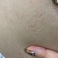 不知道是不是妊辰纹的前兆我才85斤，而且还不是肚子下面是上面胸下面，这到底是啥，难道是昨天自己搓澡...