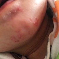 下巴长的什么？是奶藓还是湿疹？怎么办