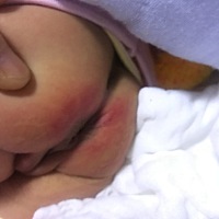 娃红屁股流屎水，整晚哭闹不知道怎么办了😢