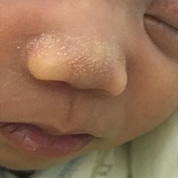 有知道宝宝鼻头怎么回事的吗？什么时候能消