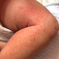 宝宝14天 昨晚腿上长了一大片疙瘩 急死了 要下去医生才上班 有宝妈知道这是这么吗 急急急