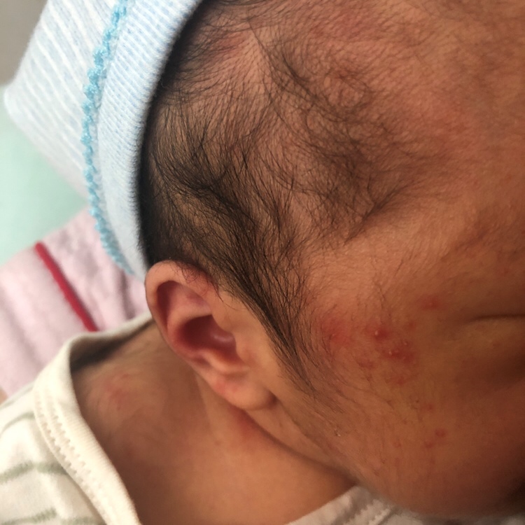 有没有宝宝有同款疹子得，出生第五天了，每天都有，医生说热得，穿少了还是有，有没有什么方法比较好的