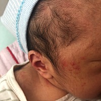 有没有宝宝有同款疹子得，出生第五天了，每天都有，医生说热得，穿少了还是有，有没有什么方法比较好的