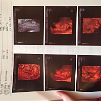 总感觉宝宝的下嘴唇好厚，真不知道，什么上嘴唇未见明显连续中断！！！！