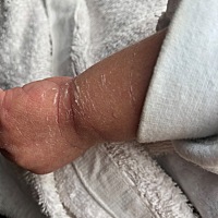 有哪位宝妈知道宝宝身上脱皮怎么回事啊？就是白白的薄薄的一层，特别是手上脚上比较明显。是天气太干的...